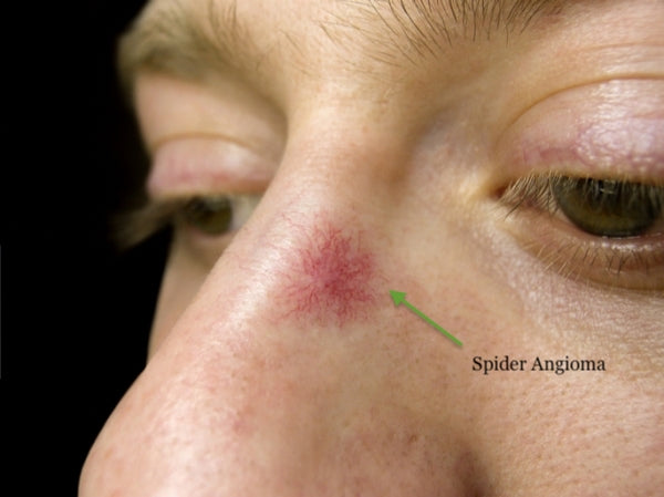 Level 5 Laser Vascular Lesion Treatment