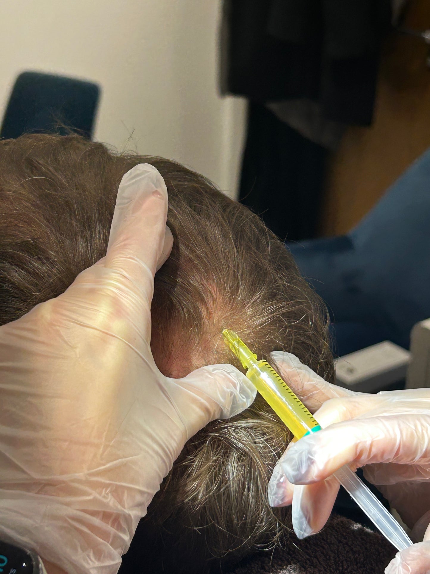 PRP for hair