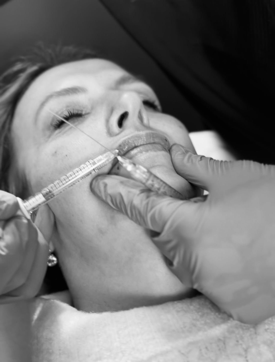 Lip Fillers: Addressing Patient Fears and Professional Responsibility
